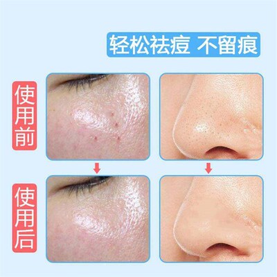 Pimple Extractor Kit, Acne Removal Tool, Blackhead Remover,