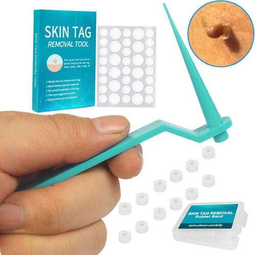1set Micro Skin Tag Remover Rubber Band Wart Remove Acne Fac