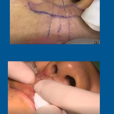 人中缩短及人中窝再造假体垫鼻基底人中成型学习视频