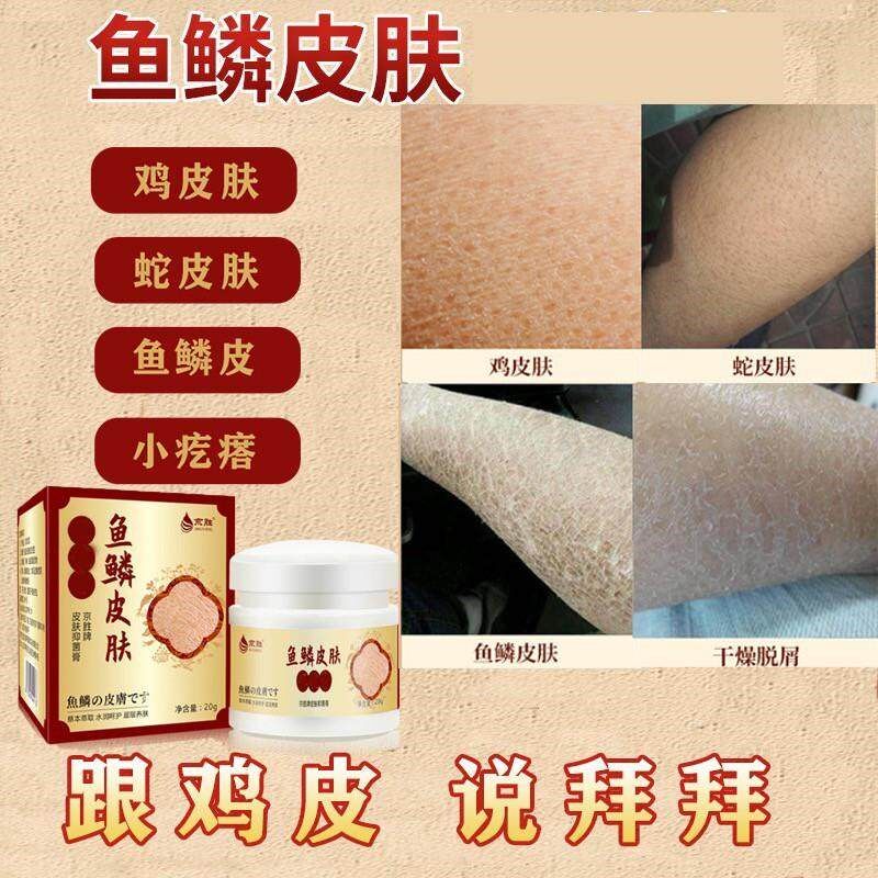 鸡皮毛周角化护理精华霜去角质蛇皮肤鱼鳞皮肤膏