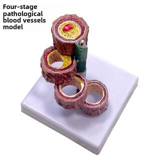 血管模型 血栓人体支脉/粥样/硬化 心血管动脉模型心内科教学通用