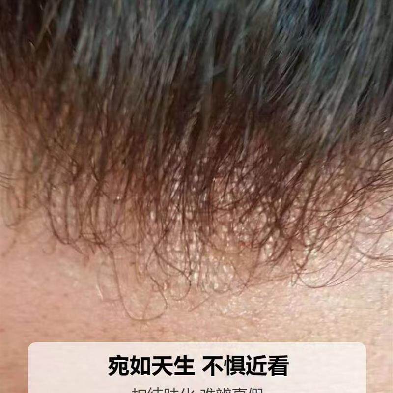 男士补发片双递针前额漂扣肤化处理头顶补发片全真发超薄生物膜