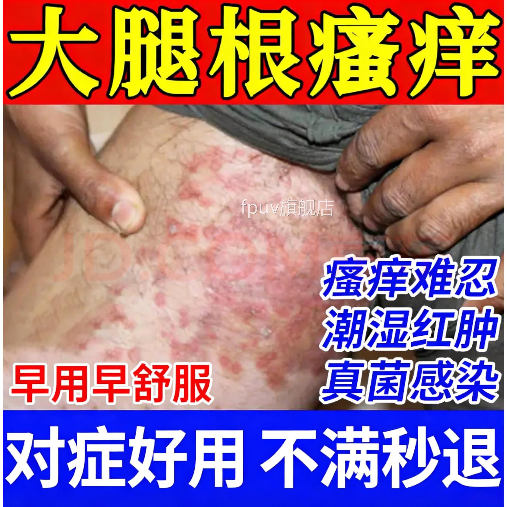 大腿内侧皮肤瘙痒股藓菌止痒去真根感染私处难闻红肿抑菌专用喷剂