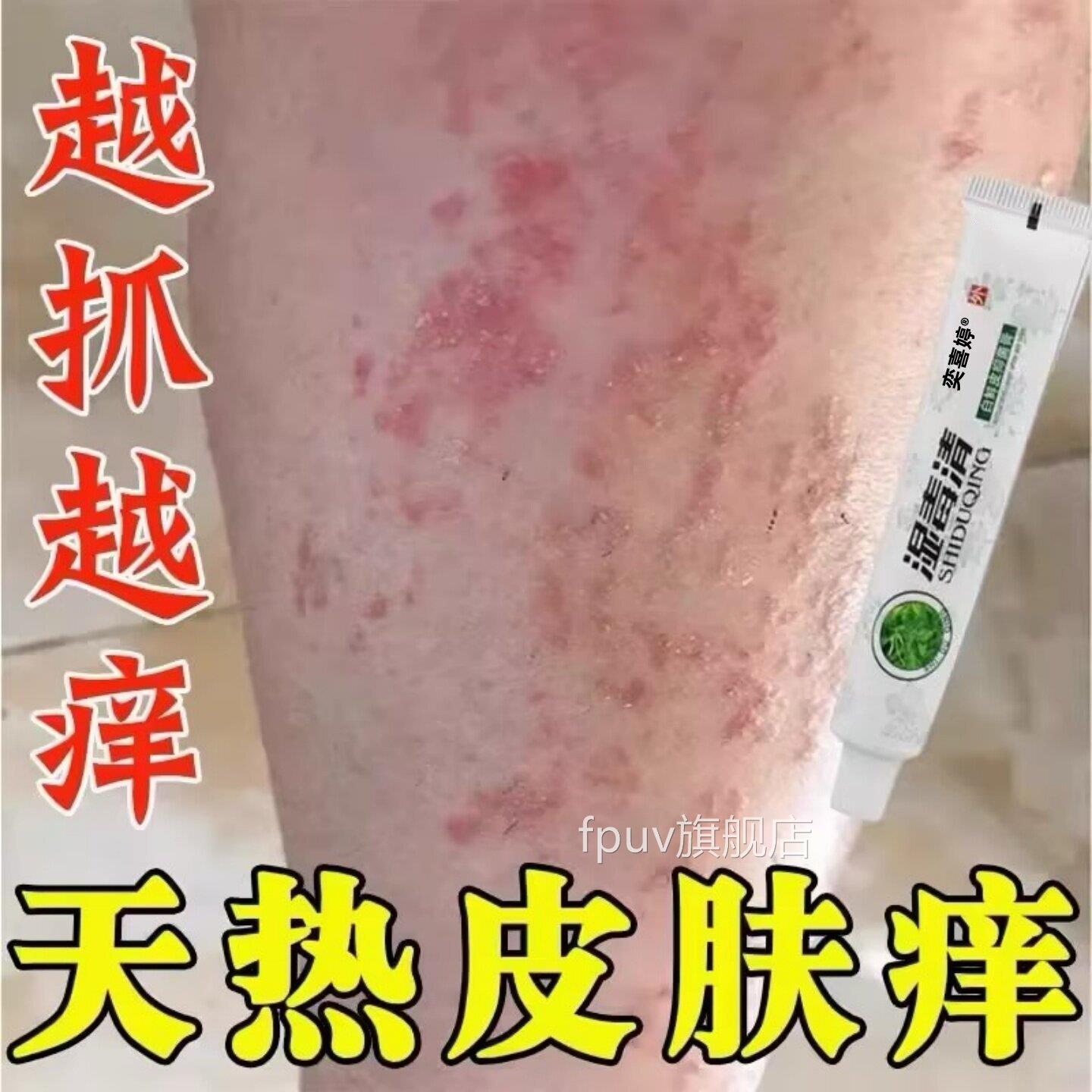 夏天小腿痒湿成人止膏出汗上痒天热皮肤疹瘙痒热疙瘩红疹身热毒痒