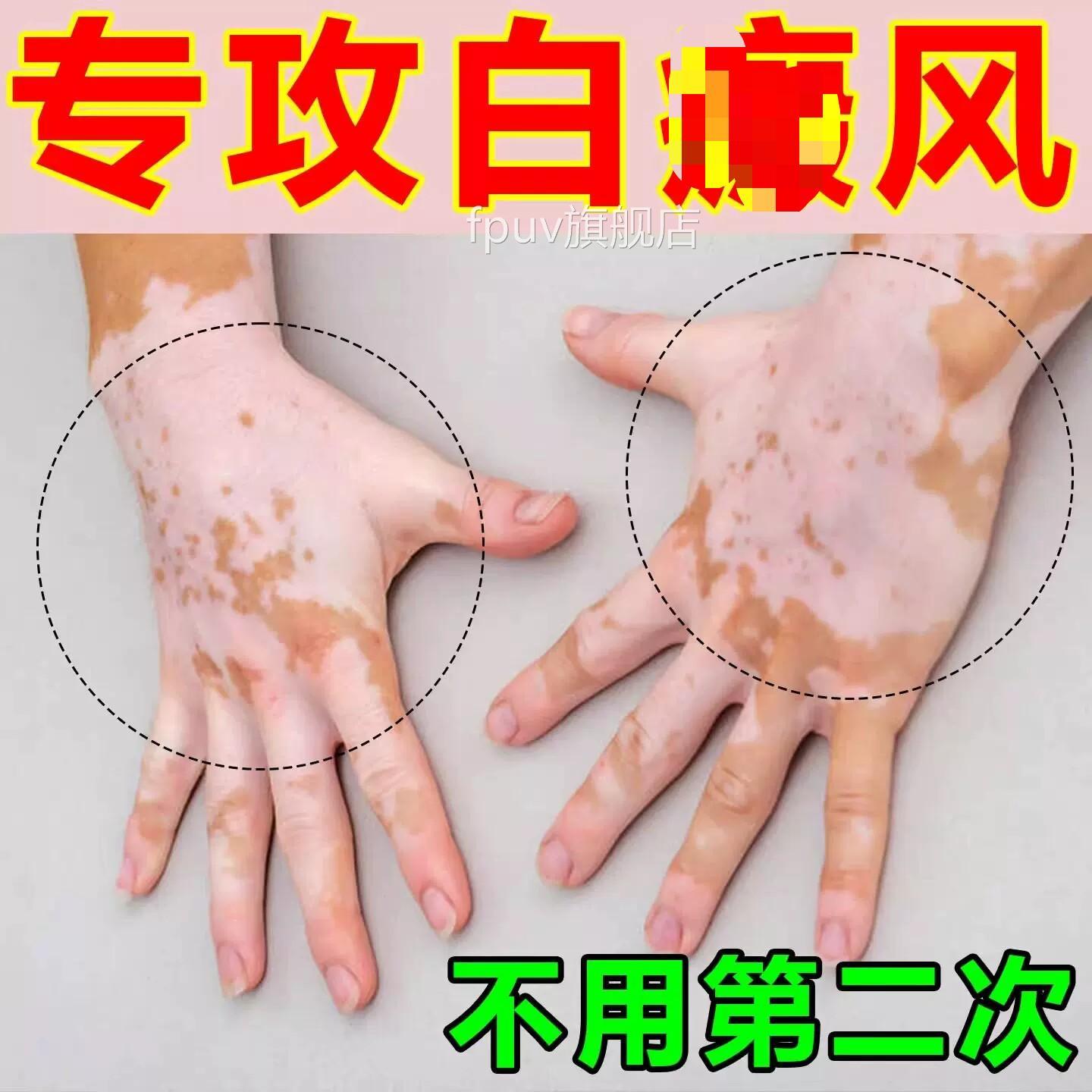 补骨脂酊癜外用膏黑色素生长专用风进白口遮盖快速消白斑正品FPUV