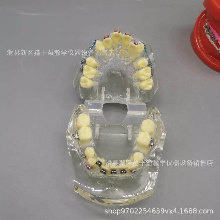 牙齿正畸模型 缺失牙错颌牙列不齐矫正 金属托槽带支抗牵引皮拉链
