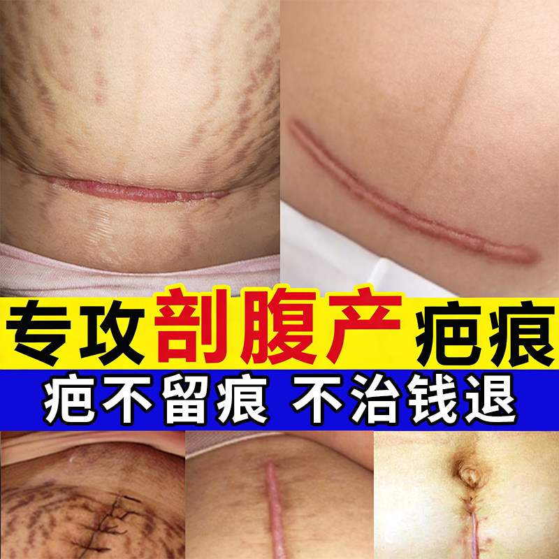 金力康花半伴夏硅酮祛疤凝胶膏成人创伤烧烫剖腹产妊娠纹增生手术