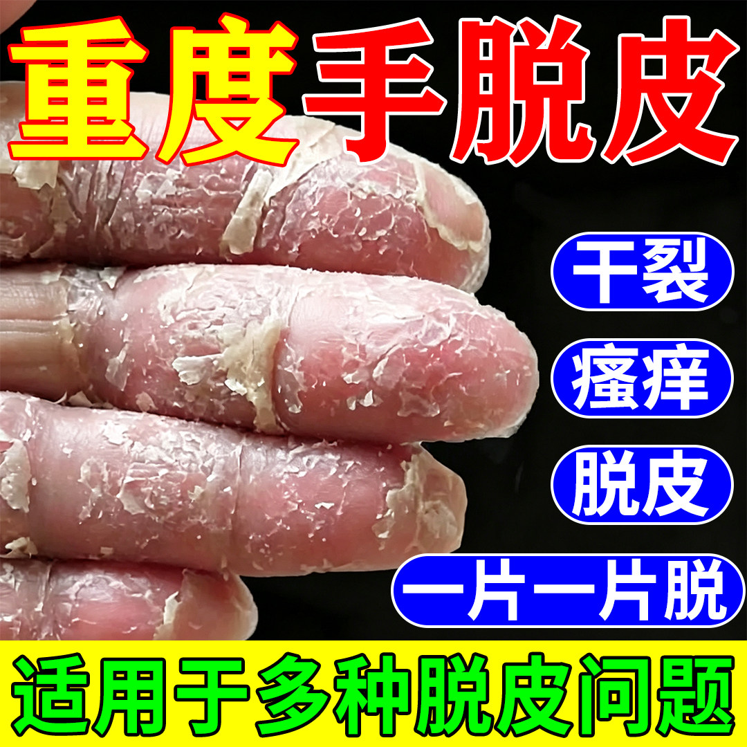 手足脱皮膏手指严重脱皮用专真菌皮肤消毒护理（消）