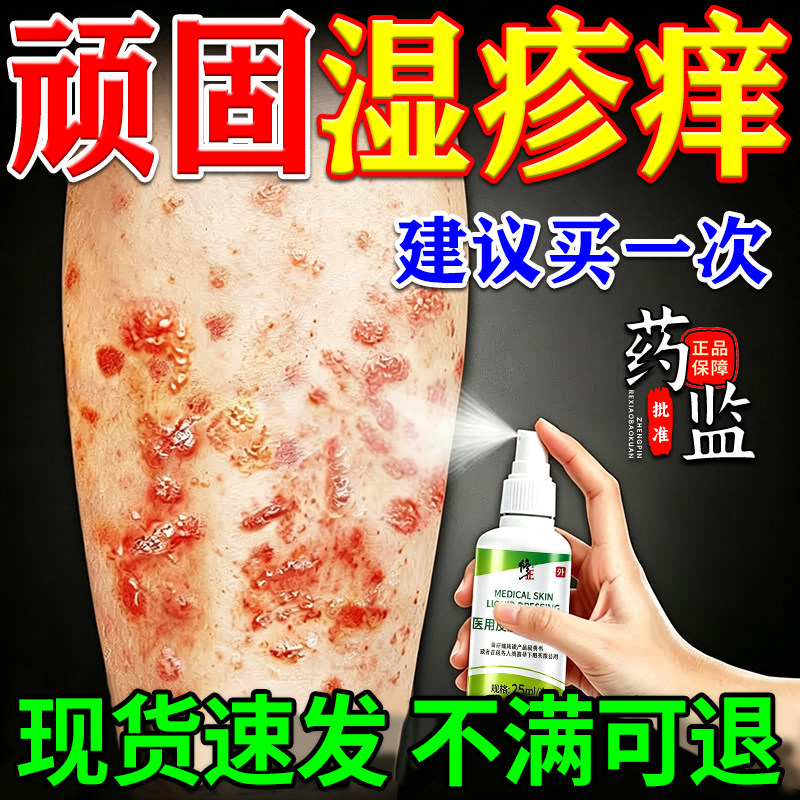 湿疹止痒外用顽固皮炎