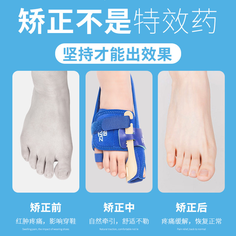 大脚趾外翻矫正器拇指外翻矫形器分趾器男女士分离大脚骨纠正支架