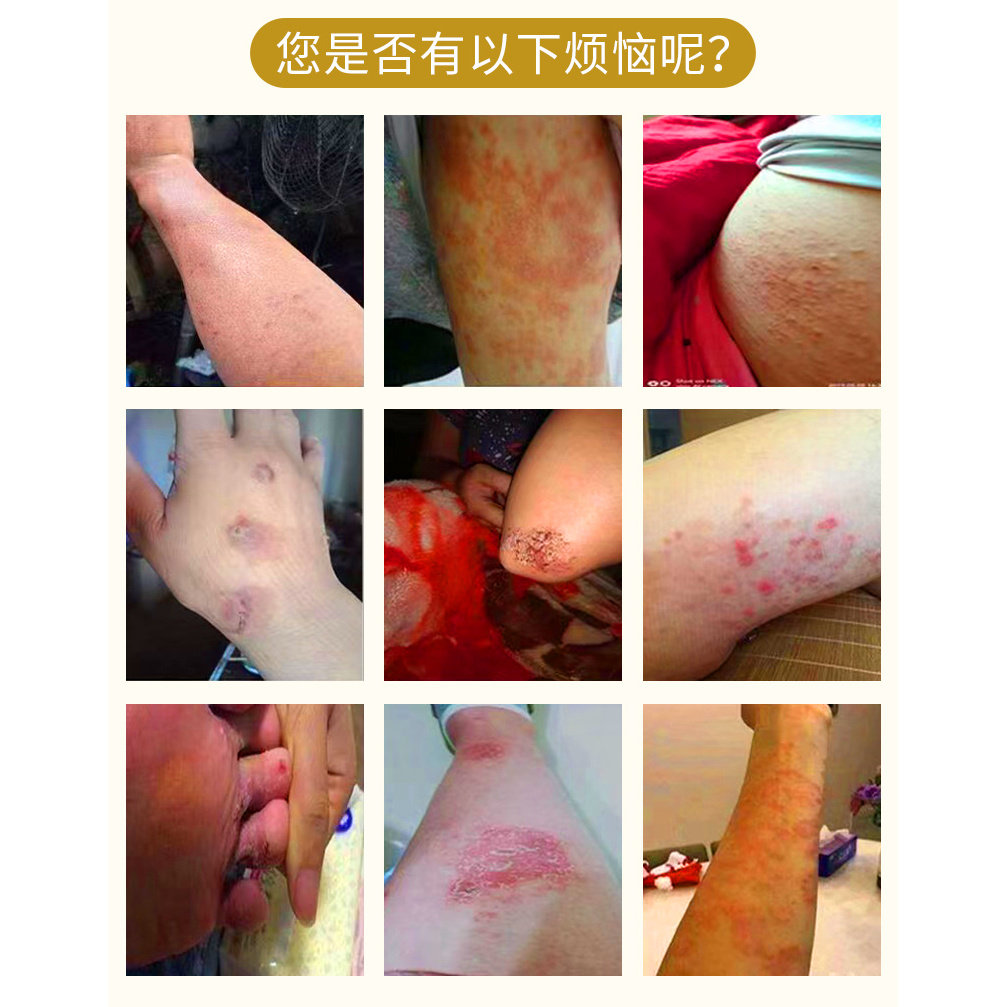 私处瘙痒牛皮湿痒顽固老年人干痒大腿股藓苗药净肛门痒特效止痒膏