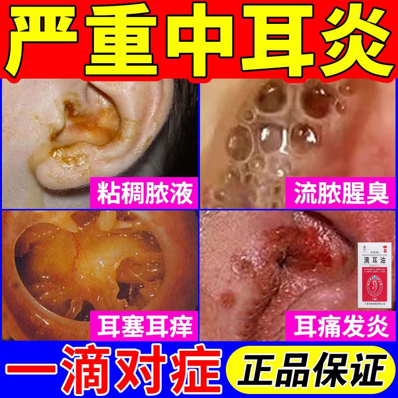 中耳炎专用药耳朵痒止痒抑菌消炎滴耳液耳鸣耳疼流脓水腥臭滴耳油