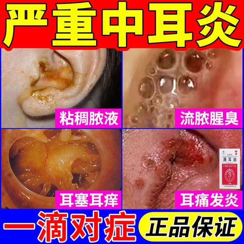 中耳炎专用药耳朵痒止痒抑菌消炎滴耳液耳鸣耳疼流脓水腥臭滴耳油