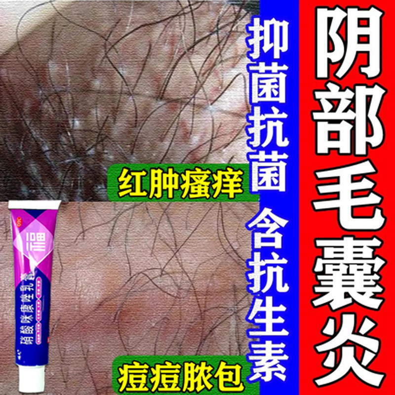 毛襄炎药膏私处消炎止痒抑菌治真菌感染外阴瘙痒有小疙瘩痘痘脓包