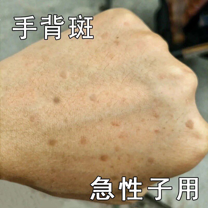 手背斑老年班脸部黑班黄褐班黑色素沉着男女通用外用皮肤修服乳膏
