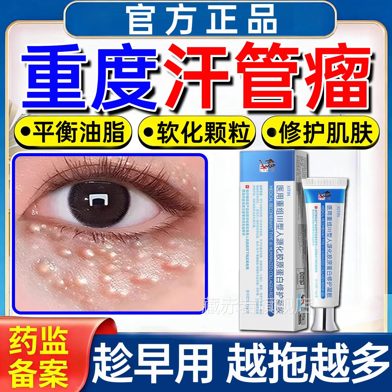 汗管眼部去除神器脂肪粒扁平疣眼周消除小疙瘩专药瘤膏用旗舰店PP