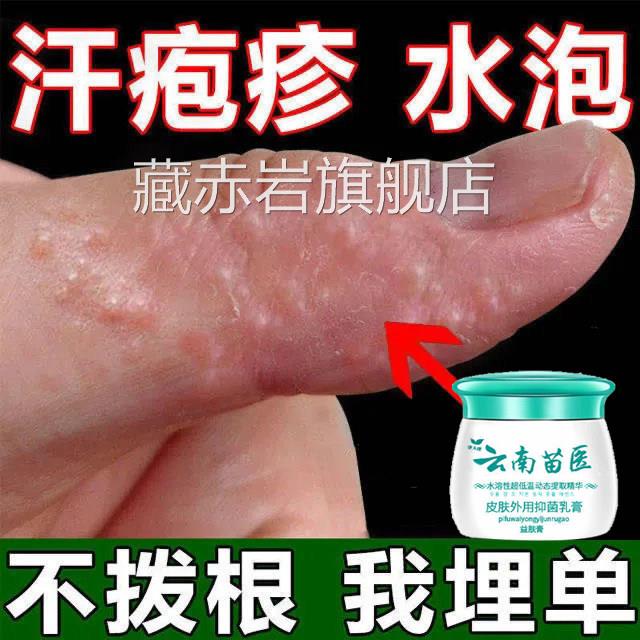 手足膏脱真皮汗疹疱手藓菌感染干裂水泡湿止痒去疹汗疹疱根乳膏颜