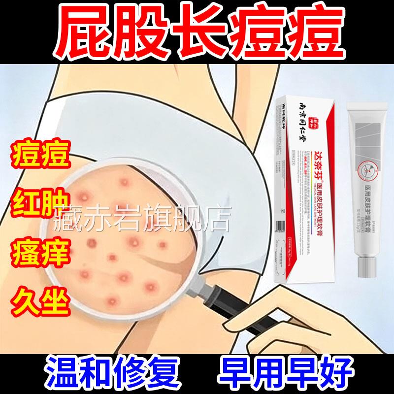 屁上长痘痘痒起热疙瘩药止股痒抑菌皮肤膏屁股痤疮久坐出汗湿痒颜