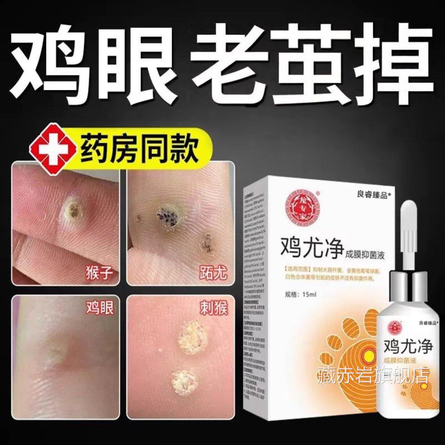 正品鸡尤平鸡眼膏贴鸡茧眼脚底脚趾脚上茧手部足部老黑肉刺鸡尤液