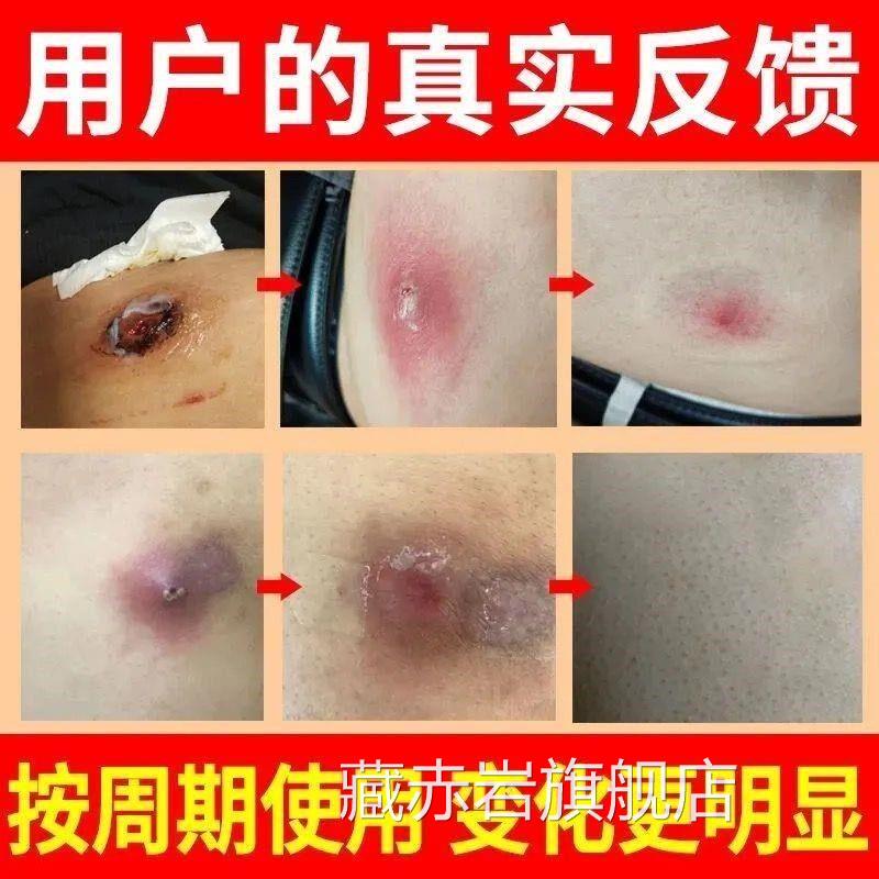 拔毒膏拔毒贴包吸脓头屁股火疖子硬块脓痘坐板疮拔脓膏吸浓贴神器