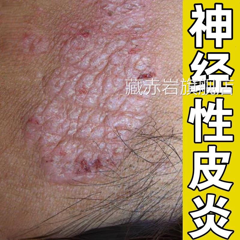 顽皮藓治疗牛皮癣银病皮肤去湿疹止瘙屑痒根特神经性皮炎专外用膏