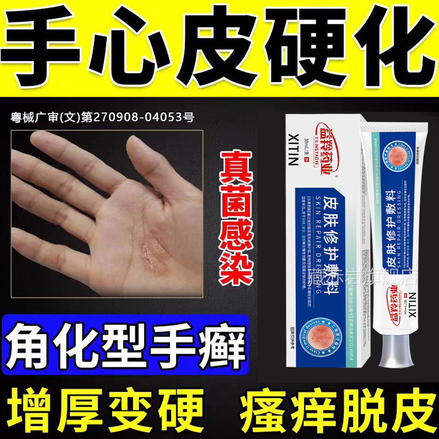 手心黄硬皮起皮角化型湿真疹手藓菌感染手癣膏药脱皮干裂鹅掌风TT
