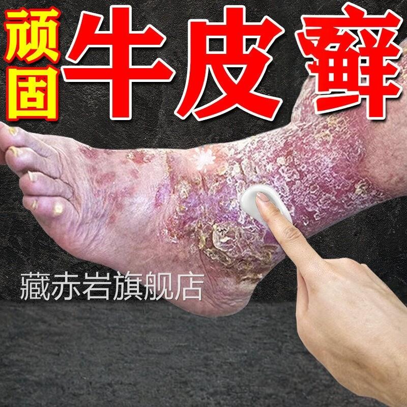 日本进口疗固性牛皮银屑效用膏药皮肤真菌感顽染杀菌颜慈安旗舰店