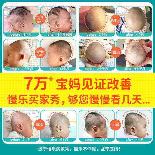 慢乐婴儿定型枕矫正头型神器舟状头扁头上扁头纠正防偏头正头枕头