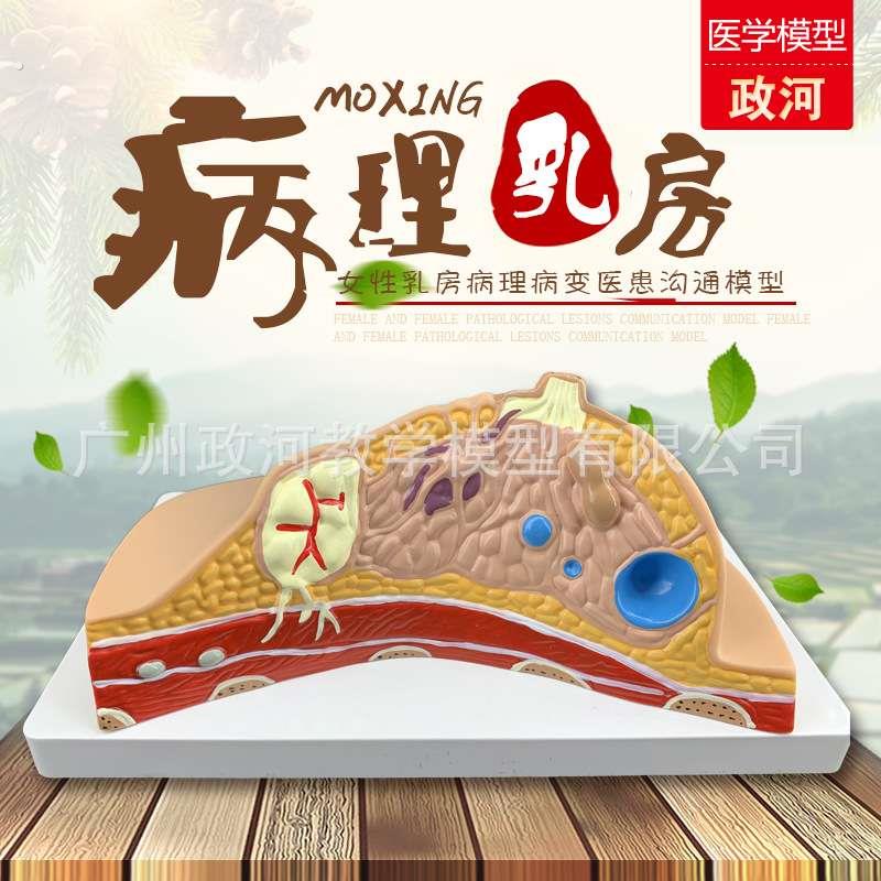 乳房病变模型乳房解剖模型 哺乳培训教具