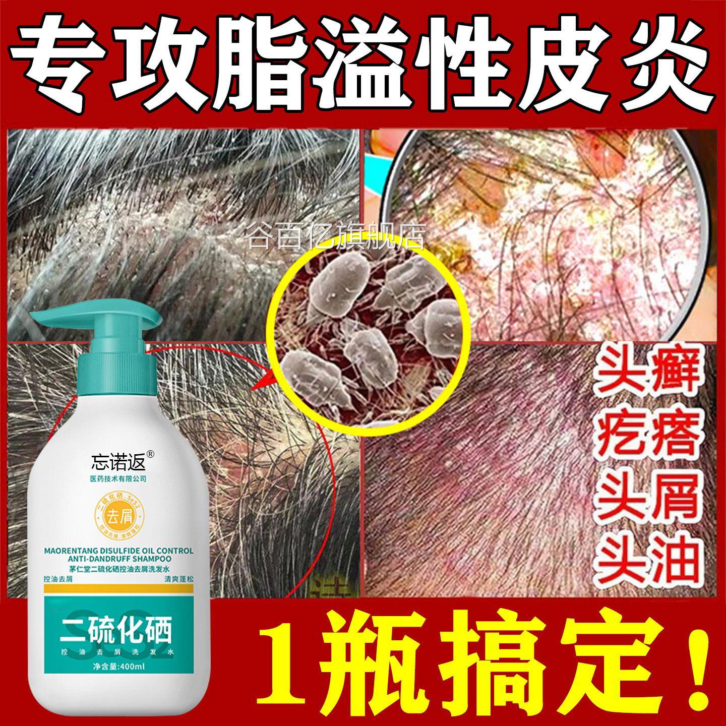 脂溢性皮化炎专洗发用水毛囊炎去屑止痒抑菌头皮屑头廯二硫硒用液