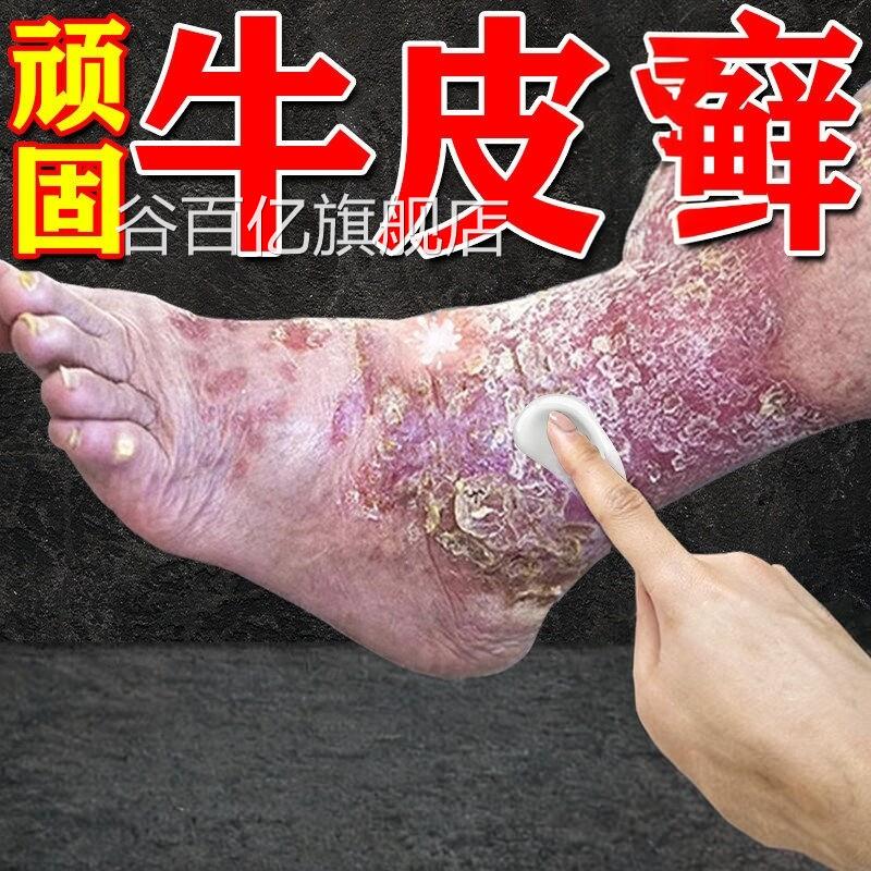 日本进口疗顽固性牛皮银效用膏药皮肤屑真菌感染杀菌谷百亿旗舰店