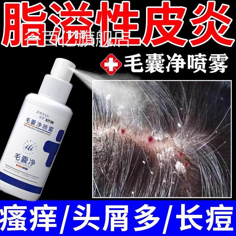 脂溢性皮炎头部剂止痒头屑头痒专用真菌感染头皮癣毛喷囊炎喷雾谷