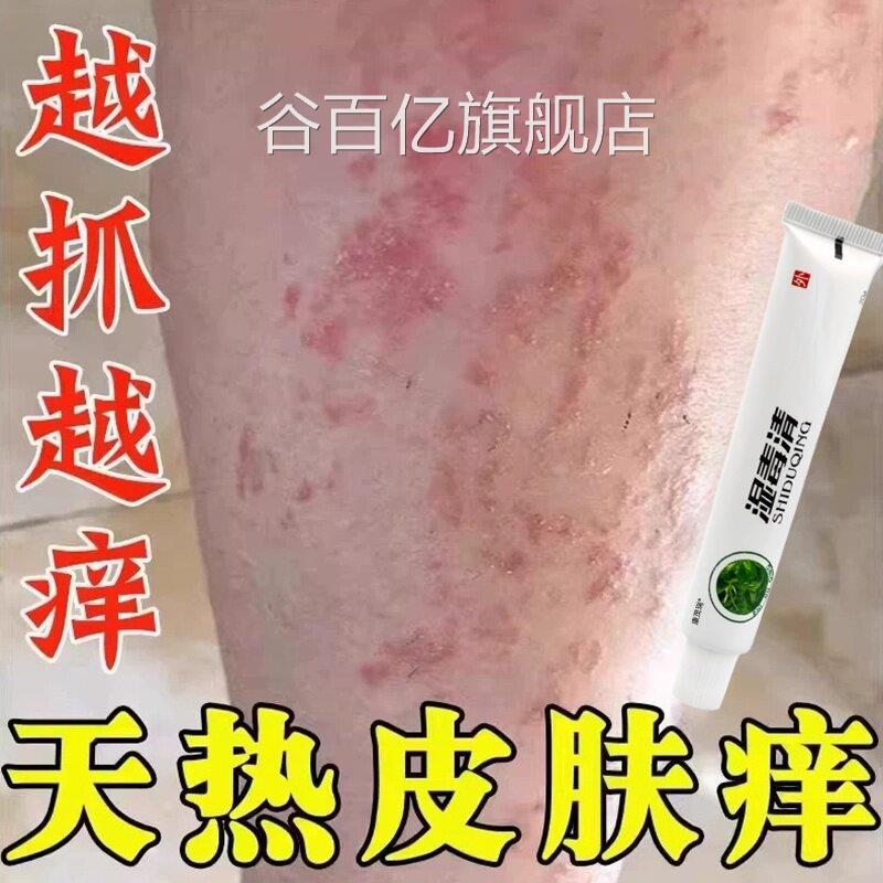夏天小腿热痒湿成人止痒膏出汗身上痒天热皮肤痒疙瘩红疹热毒谷百