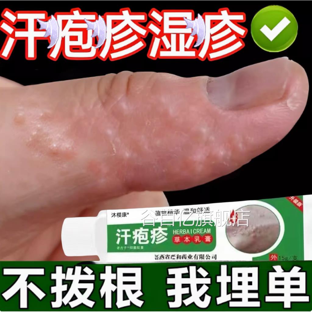 疱疹去手上起小水泡汉汗状真菌感染专用软膏干裂汗脱皮痒根谷百亿