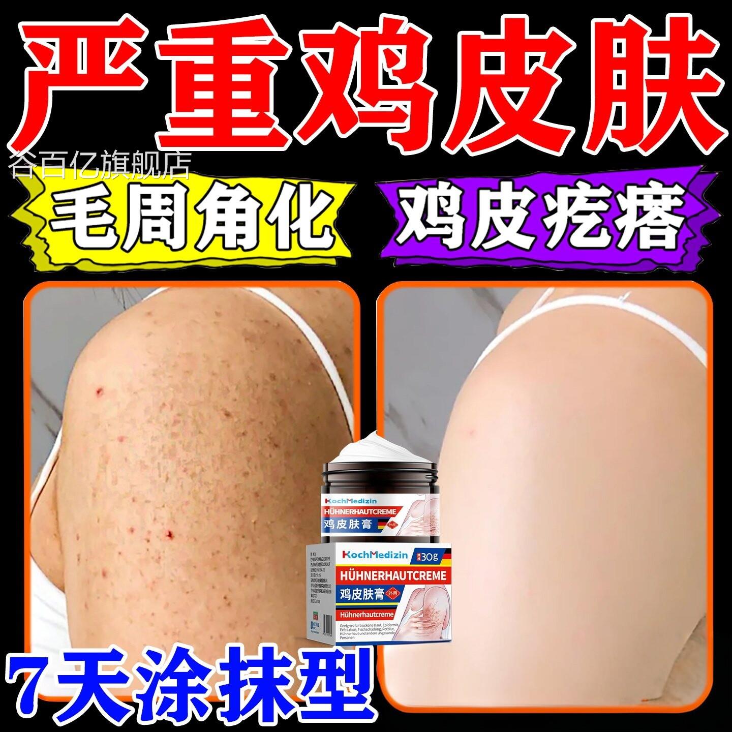 鸡器皮肤疙瘩毛囊角化症专除神全身手臂鸡皮大腿部毛囊炎痘痘谷百