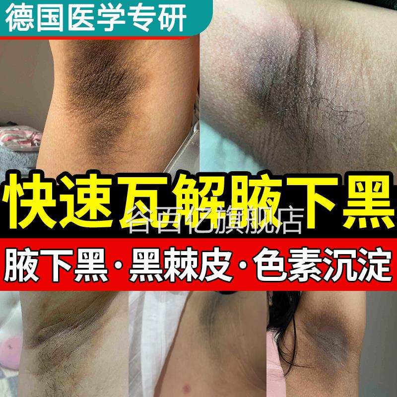 腋下去黑美腋窝除黑色素沉淀淡化黑脖子大腿内侧沉着淡白化谷百亿
