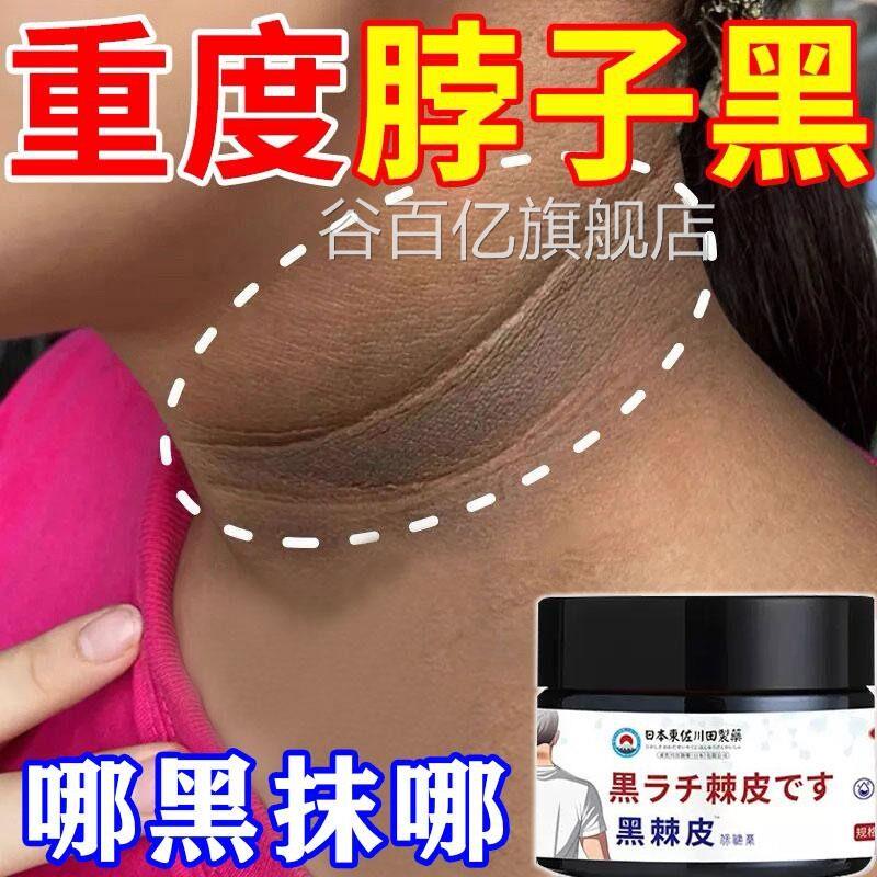 脖子黑色素去黑棘皮症脖子黑色素沉淀淡化黑棘皮药膏颈部除变白谷
