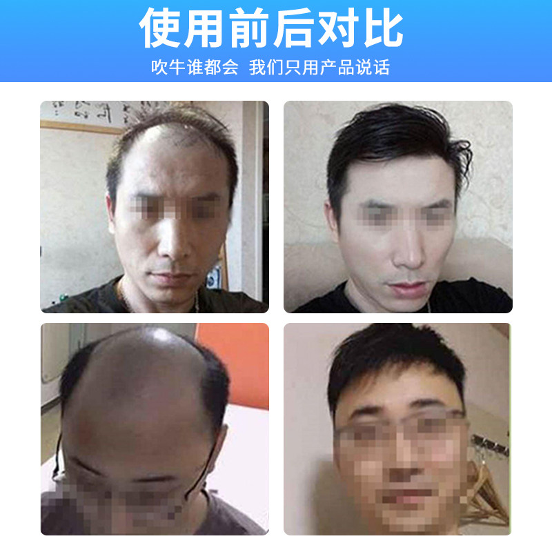 假发男头顶补发片男士头顶补发真人发丝手织补发块秃顶补发透气