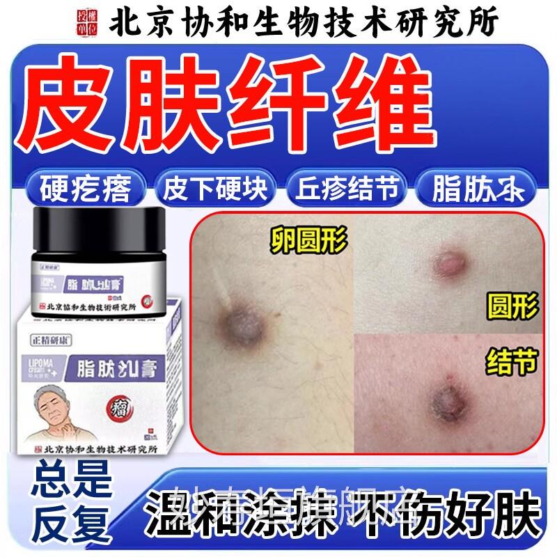 皮肤纤维瘤肿膏块去除皮下脂瘤肪消硬瘤块搭下膏药贴皮粉疙瘤瘩妙