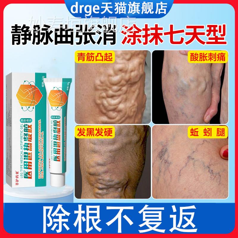 脉涩膏药贴冈静曲张冷敷凝胶蚯蚓腿小腿酸麻木肿胀青筋凸起红血丝