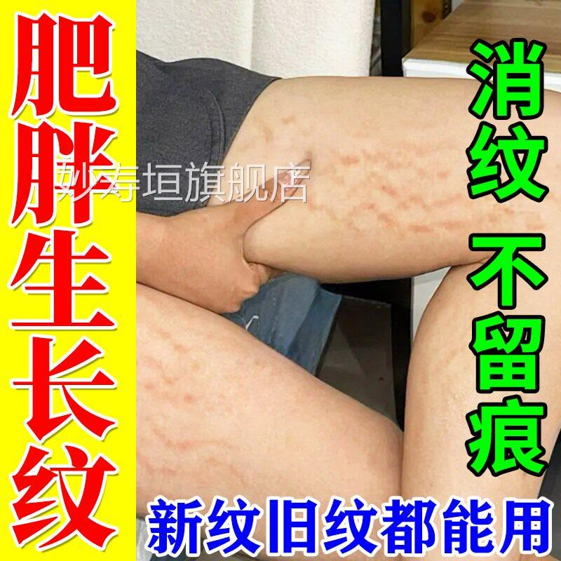 去除肥胖复纹青少年专用学生消除大腿生长纹修霜紧致肚皮去妊娠纹
