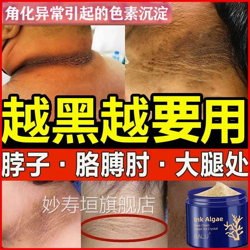 去脖子黑色素去除黑棘后脖子去除颈部黑色素沉淀洗皮不干净清洁膏