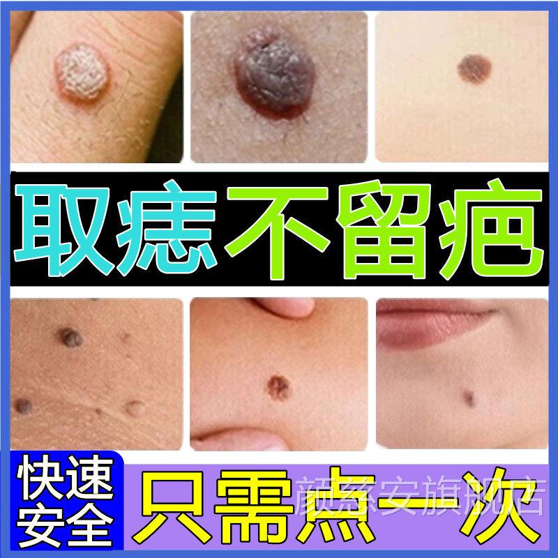 去白云山点痣膏无痕修复痣美容院专用祛痣不留疤药水正品旗舰店颜