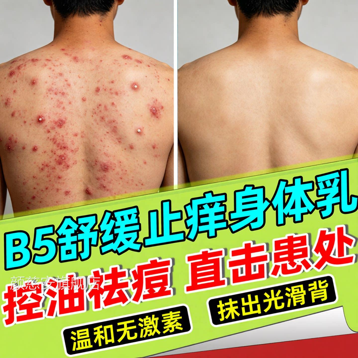 马拉色菌前胸后背部祛痘过氧化苯甲酰粉末黑印乳身体涂抹身体乳膏