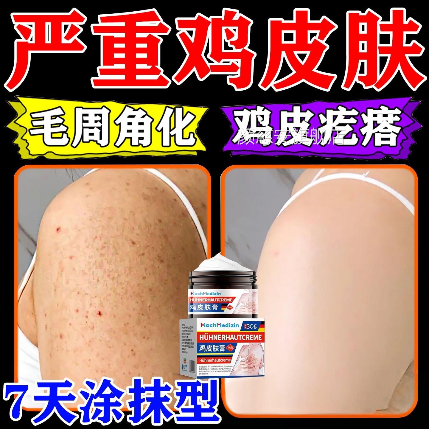 鸡皮肤疙瘩毛囊角化症专除神器身手臂鸡皮大腿全部毛囊炎痘痘颜慈