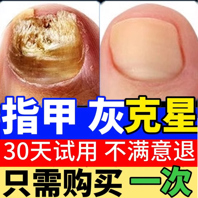 灰指甲脱甲膏专用修复液去除增厚趾甲护理盒抑菌液正品官方旗舰店