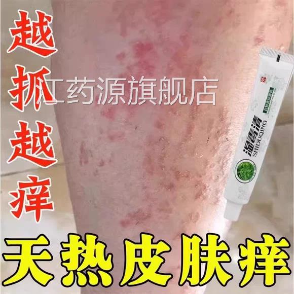 夏天小腿痒湿成人止膏出汗身上痒热天皮肤疹瘙痒热疙瘩红疹热毒痒