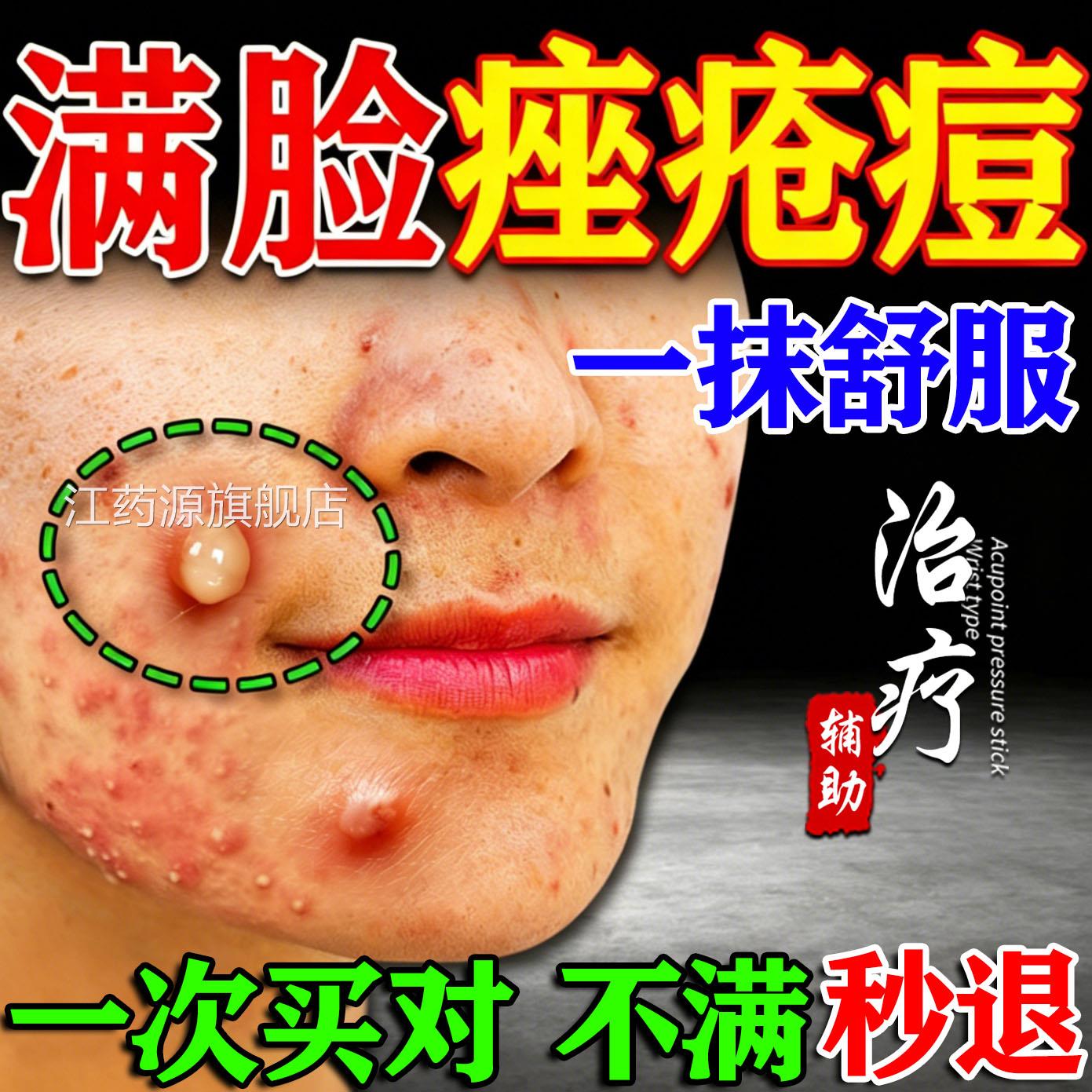 重玫瑰痤疮膏药特去青效春痘度暗疮祛痘印粉刺闭口修复屏障剂江药