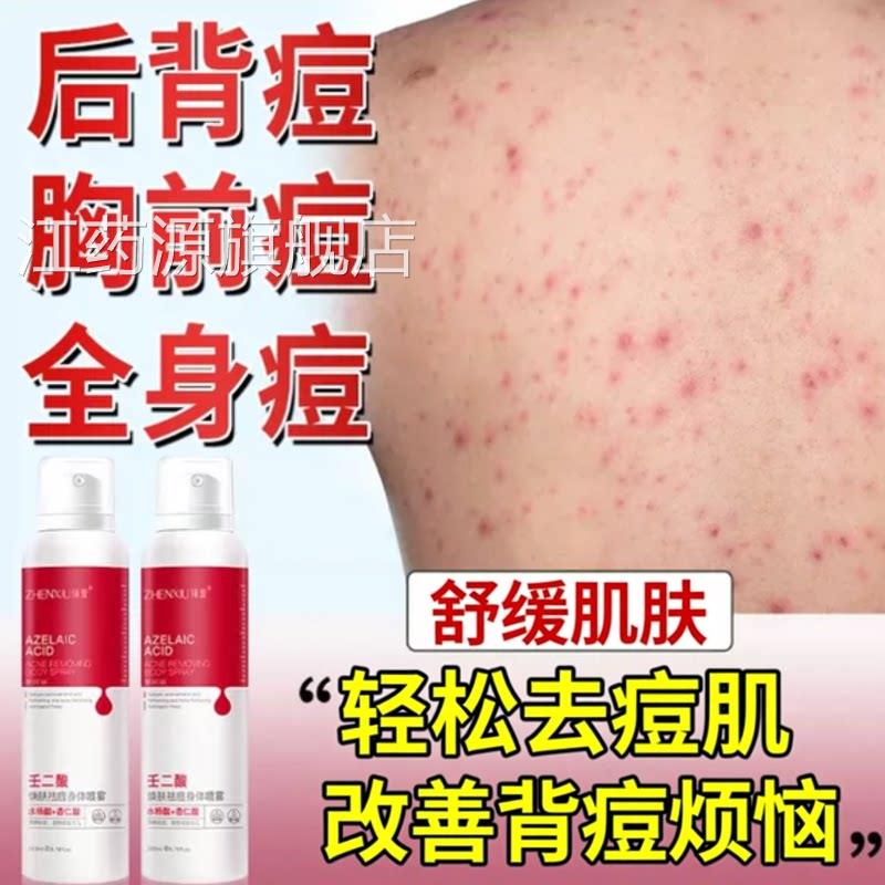 背粒消背上长痘痘毛胸囊炎除螨祛痘痒喷雾剂背后背前胳膊手臂上痒