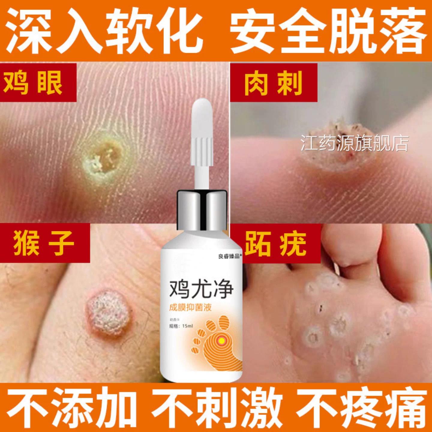 跖疣病毒疣连根拔专用贴趾疣水冷冻除疣液氮根去脚底疣膏除江药源